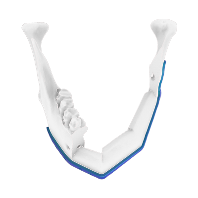 Img titanium implant for mandibular reconstruction with fibula flaps top view
