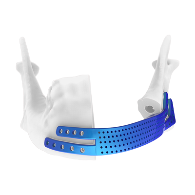 Img titanium implant for mandibular reconstruction with anatomical plates front view