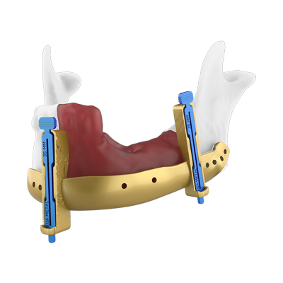 Img surgical guide for mandibular reconstruction with anatomical plates