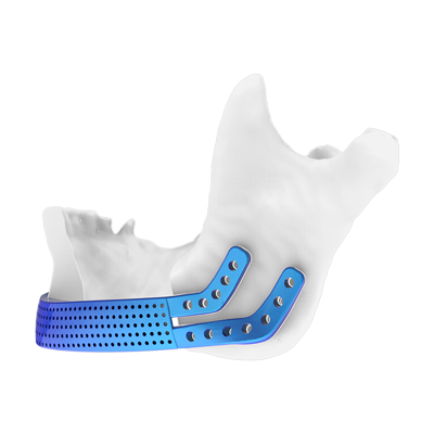 Img titanium implant for mandibular reconstruction with anatomical plates lateral view