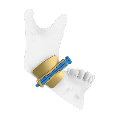 Img guía quirúrgica para cirugía ortognática mandibular vista lateral