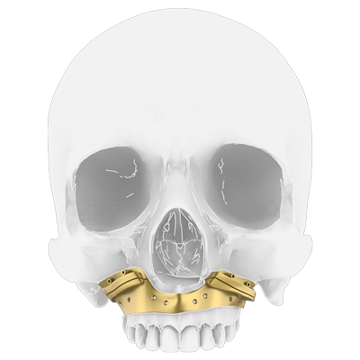 Img surgical guide for maxillary orthognathic surgery