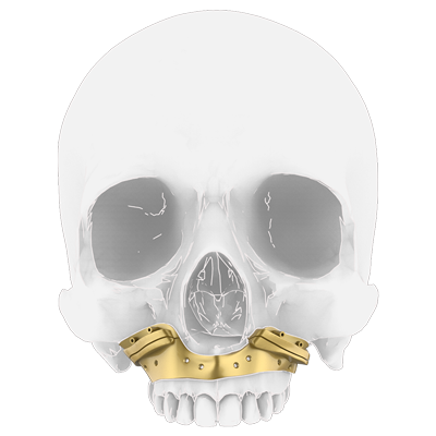 Img guía quirúrgica para cirugía ortognática maxilar