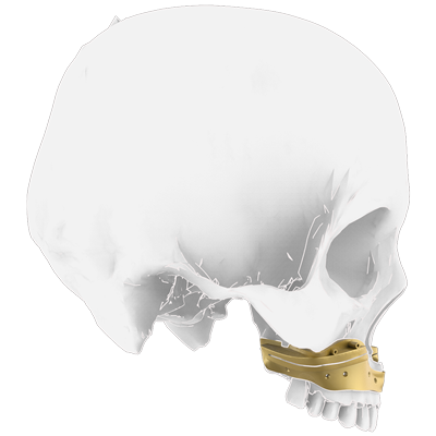 Img surgical guide for maxillary orthognathic surgery lateral view