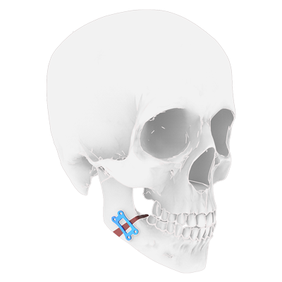 Img implante en titanio para cirugía ortognática mandibular