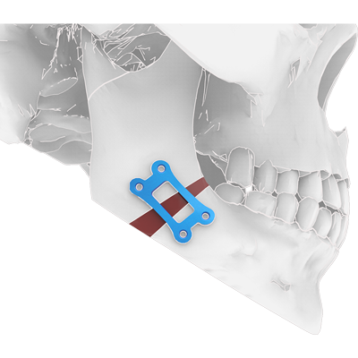 Img titanium implant for mandibular orthognathic surgery lateral view