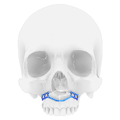 Img titanium implant for maxillary orthognathic surgery