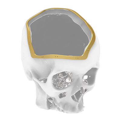 Img surgical guide for cranial bone reconstruction implant