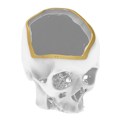 Img guía quirúrgica para reconstrucción ósea craneal
