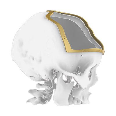 Img surgical guide for cranial bone reconstruction implant lateral view