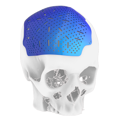 Img titanium implant for cranial bone reconstruction
