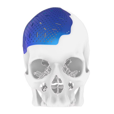 Img titanium implant for cranial bone reconstruction front view