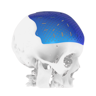 Img titanium implant for cranial bone reconstruction lateral view