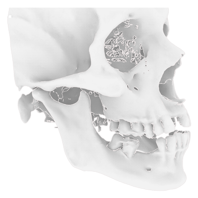 Img TMJ prosthesis step 1