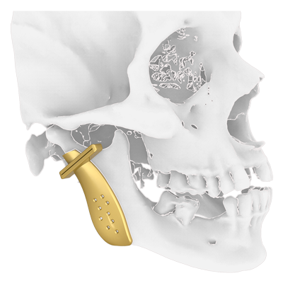 Img TMJ prosthesis step 2 surgical guide