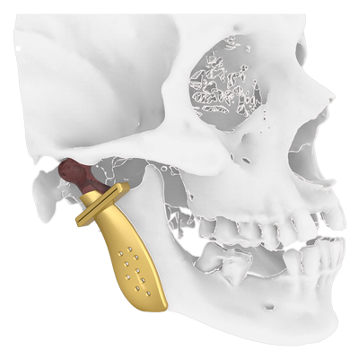 Img TMJ prosthesis step 3 surgical guide