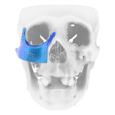 Img implante en titanio para fractura del arco cigomático vista frontal